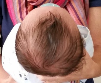Understanding Flat-Head Syndrome: Causes, Consequences, and Prevention