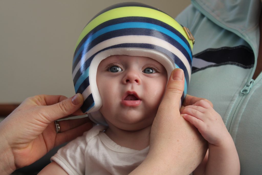 How Common is Plagiocephaly and Flat Head Syndrome?