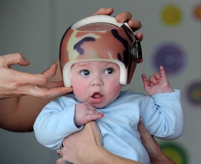 Exploring Treatment Protocols for Plagiocephaly